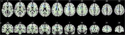 Pedunculopontine Nucleus Dysconnectivity Correlates With Gait Impairment in Parkinson’s Disease: An Exploratory Study